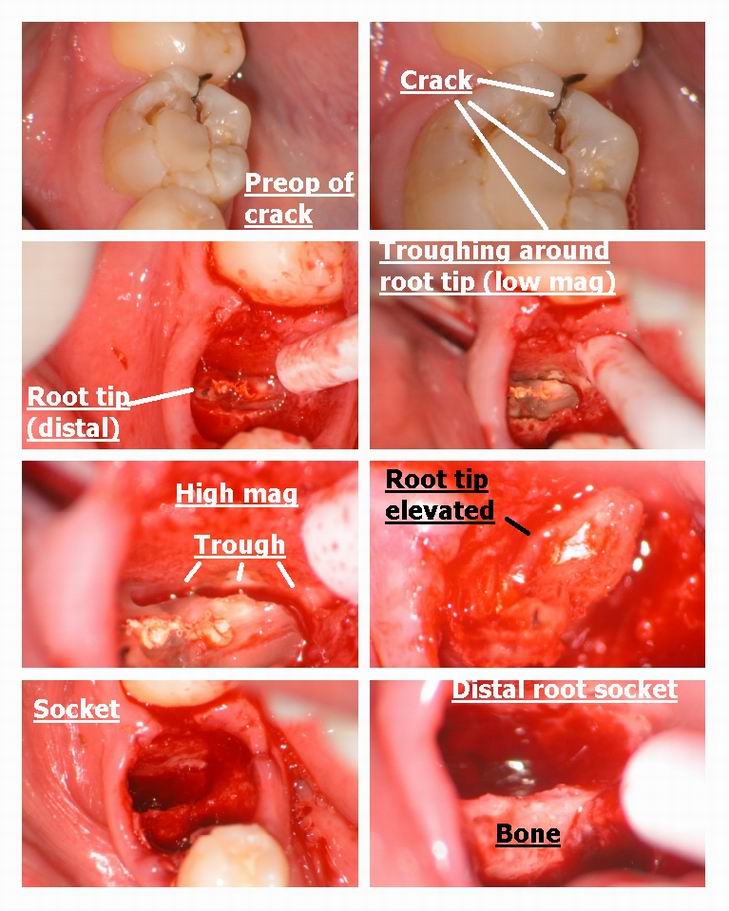 Resize of Extraction of Root pt one.jpg